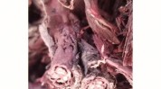 紫草肉芽肿乳腺炎益气后期汤加减(肿块紫草乳腺炎肉芽肿患者)