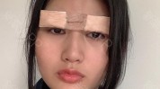 胶布双眼皮做完爱德(胶布双眼皮做完爱德术后)