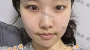 就做项目(脸型的人就做项目手术)