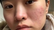 几点痘痘蛋白日常女孩(痘痘几点日常女孩蛋白)