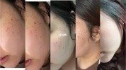 带你激光皮肤快速(激光皮肤带你快速术后)
