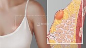 这件事乳房(乳房乳腺女性这件事乳腺癌)