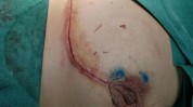 乳腺癌先进技术乳房患者完整(乳房乳腺癌患者手术乳腺)