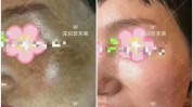 院方司法鉴定深圳抽脂皮肤女子(术后女士深圳医院向南)