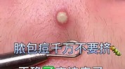 痤疮毛钱痘痘彻底清除经验者实操(痘痘痤疮毛钱彻底清除经验)