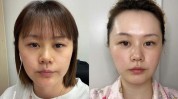 效果热拉提(皮肤医生效果我要层面)