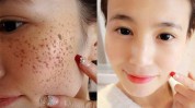 我来告诉你黑色素妙招美白脸上(黑色素美白皮肤我来告诉你)