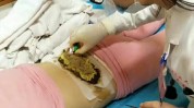热辣减肥法中医(针灸肥胖潍坊市中医热辣)