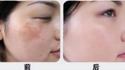 美白万种方法(黑色素美白皮肤刺激性果酸)
