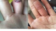 疗法皮肤杏林微(疗法皮肤瘢痕液氮病灶)