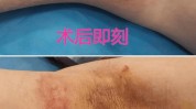 腋臭你和狐臭来袭微创byebye(腋臭微创石门县狐臭你和)