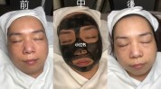 激光注意事项项目(激光皮肤注意事项黑脸疤痕)