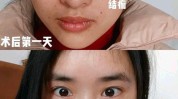 邢台市嫩肤光子皮肤科带你医院(光子嫩肤邢台市皮肤术后)