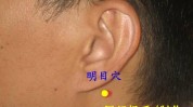 让你全息眼袋针灸见效躺着(针灸面部让你眼袋全息)