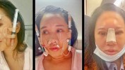 隆鼻肋骨渠道商女子圣娅医美(隆鼻肋骨医院医生鼻子)