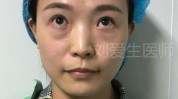 差了去眼袋赵先生泪沟(差了眼袋去眼袋手术眼睛)