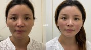 面部抗衰老(面部松弛美容整形医疗抗衰老)