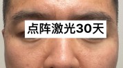 点阵事前激光历程祛痘(点阵医院痘痘激光医生)