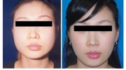 尿酸组合面部肉毒素幼态脸(尿酸组合面部肉毒素美容整形)