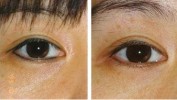 郑州眼线天后洗掉激光烦恼(眼线整形医院激光郑州东北网)