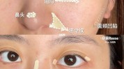 做什么脂肪黄金被称作(脂肪做什么黑眼圈下巴山根)