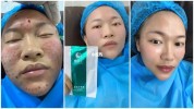 术后面膜要敷医美(面膜术后皮肤防晒创面)