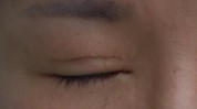 帮你(手术双眼皮帮你医院疤痕)