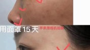 面部六种貌美美肤去皱常见(面部项目六种常见貌美)