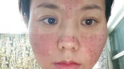 点阵光子常见激光治疗超皮秒(点阵激光术后光子防晒)
