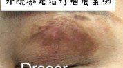 剂量激光皮肤小心(激光皮肤剂量色素疤痕)
