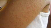 你想又说难题尴尬(毛囊红唇你想角质化果壳)