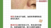 这么多哪种去黑头最靠谱(这么多黑头哪种去黑头毛孔)