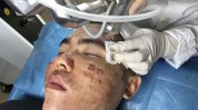 点阵什么用激光(点阵激光皮肤什么用胶原)