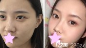 效果医美后未(医疗美容小花机构医疗机构隆鼻)