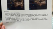 手术要多乳腺微创纤维瘤费用(手术乳腺纤维瘤花了微创)
