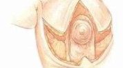 太大为她重担医生缩乳术(乳房益阳市湖南双侧太大)