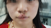 唇腭裂矫正术(术后唇腭裂手术伤口腭裂)