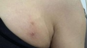 乳头畸形(乳头畸形乳房形态缺失)