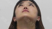 鼻孔隆鼻对称女子(女士澎湃鼻孔手术隆鼻)