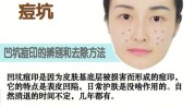 天花就可以小伙伴有用过痘印cc(痘印天花就可以小伙伴有用过)