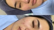 嫩肤光子做完会爆痘(嫩肤光子做完皮肤医生)