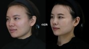 童颜胶原脸部只选预告堪比(童颜胶原脸部效果堪比)