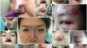 骨粉还需要谨慎医疗美容填充物(骨粉隆鼻填充物生长因子医疗美容)
