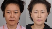 拉皮来了堪比手术科技抗衰黑(拉皮拉美来了手术堪比)