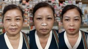 二十多位慎重老人纹眉(乐清中老年人中老年负责人手术)