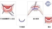 下巴几种方法(下巴尿酸下颌假体几种方法)