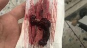 盆腔美容院都去效果(盆腔月经名媛效果血块)