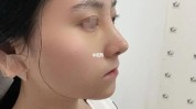 也能女神素人翘鼻(隆鼻软骨手术荆州自体)