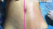美丽妊娠纹(妊娠纹胎儿准妈妈美丽腹部)