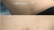 万元疤痕美容院多处抽脂身上(李女士疤痕万元抽脂西安)